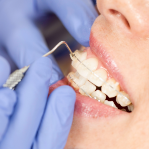 Kontrola keramických rovnátek u ortodontisty