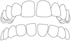 Ortodontické vady - mezery mezi zuby