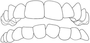 Ortodontické vady - stěstnané zuby