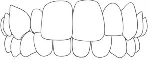 Ortodontické vady - zkřížený skus